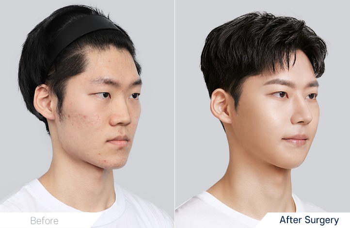 before_after_45º