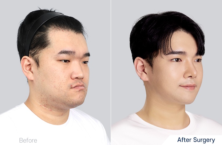 before_after_45º