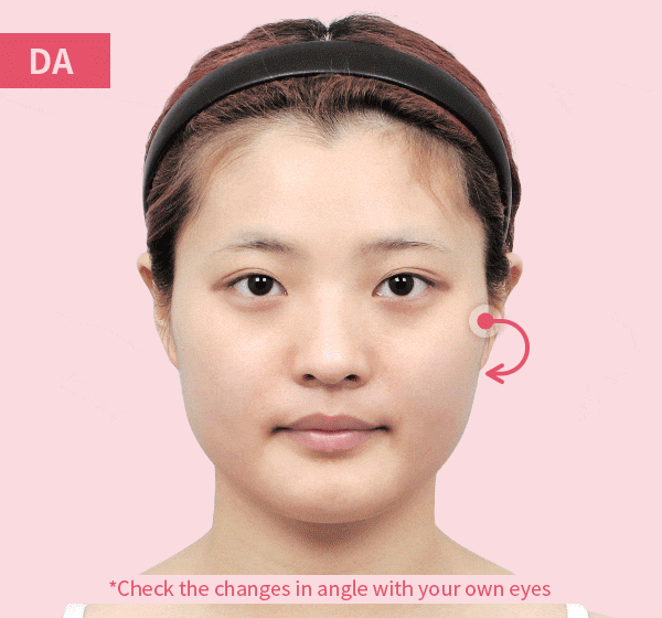 DA’s unique Turning Zygoma Reductiononly cuts precisely equal to the size of the bone that will be clinched and turns the cheekbone to the prettiest position.
