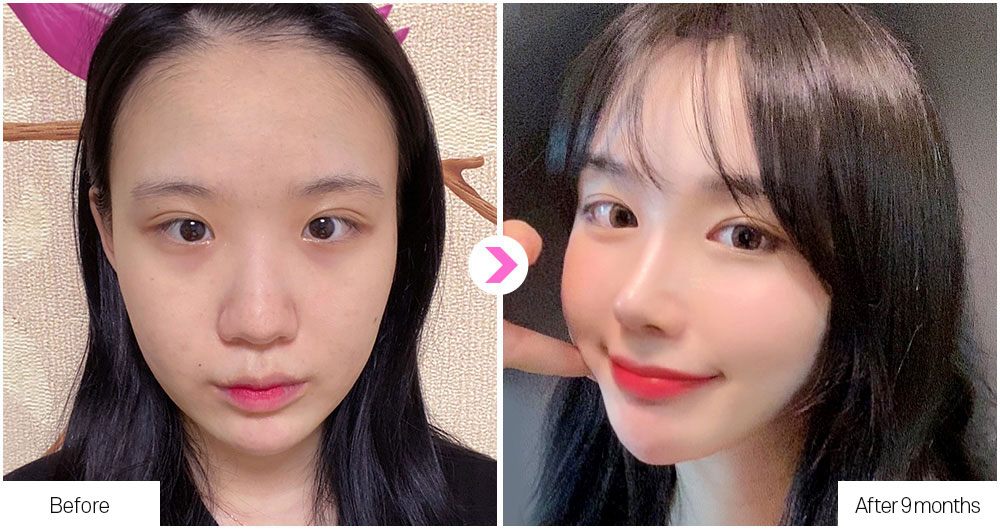 DA Flat Nose Surgery before&after