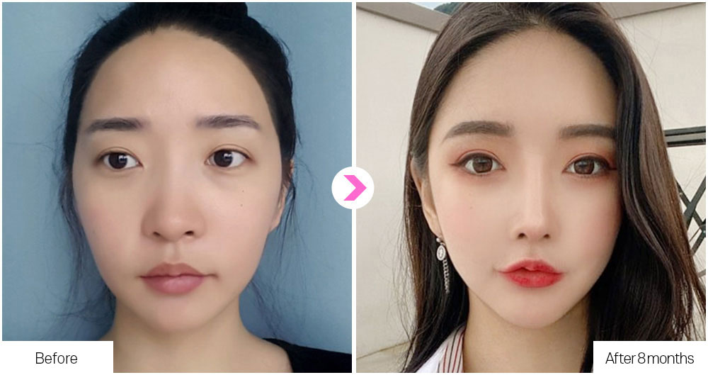 DA Flat Nose Surgery before&after