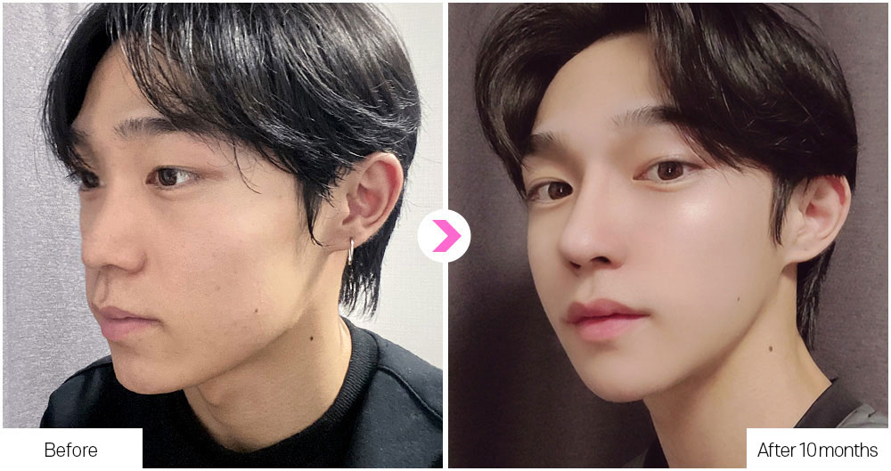 DA Flat Nose Surgery before&after