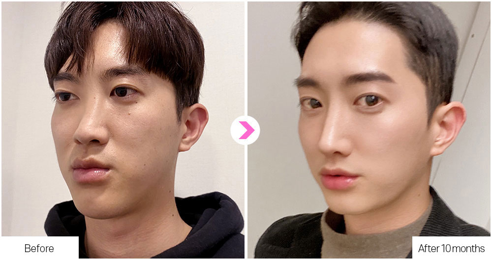 DA Flat Nose Surgery before&after