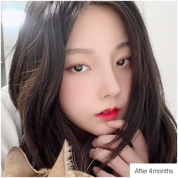 DA Short nose, Upturned nose before&after