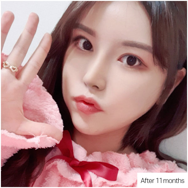 DA Short nose, Upturned nose before&after