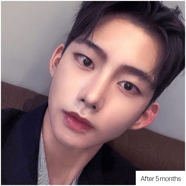 DA Short nose, Upturned nose before&after