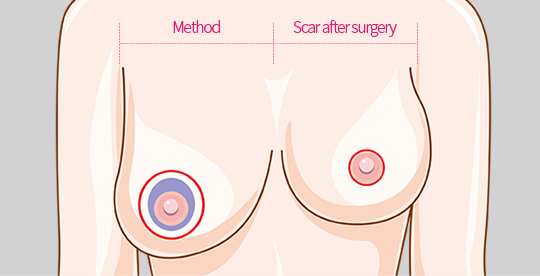 CASE01. Light-Breast Hypertrophy