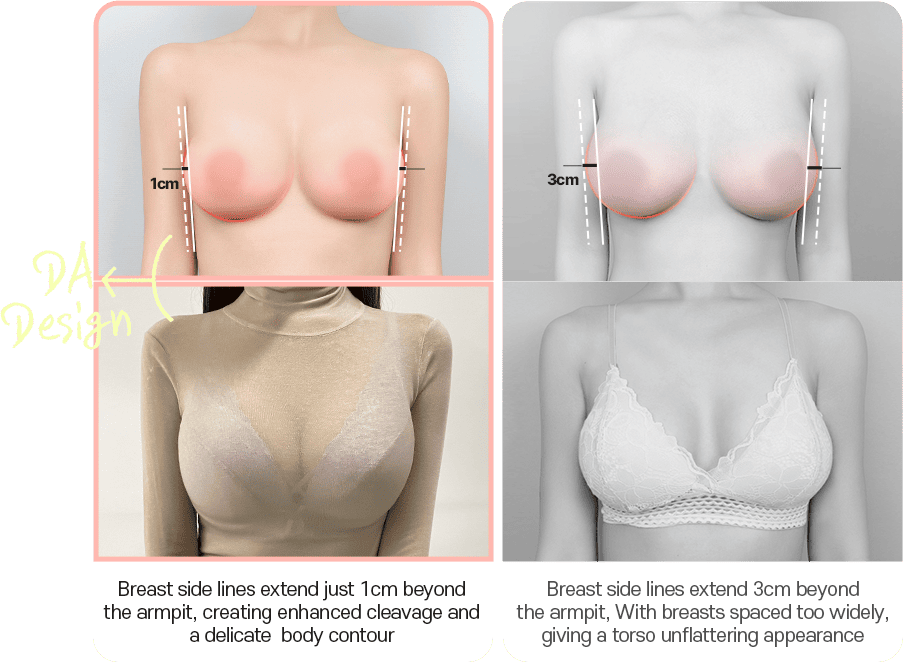 DA breast augmentation