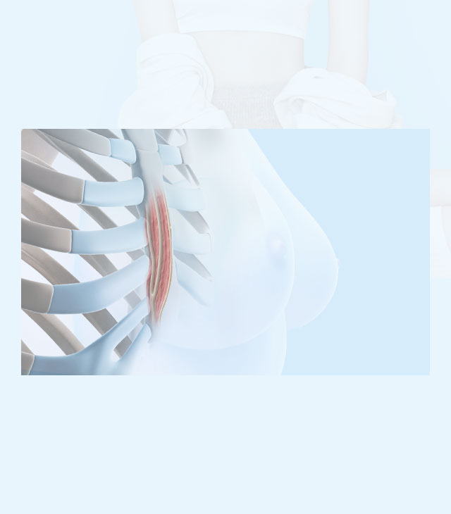 Significant change of breasts texture and shape after breast augmentation