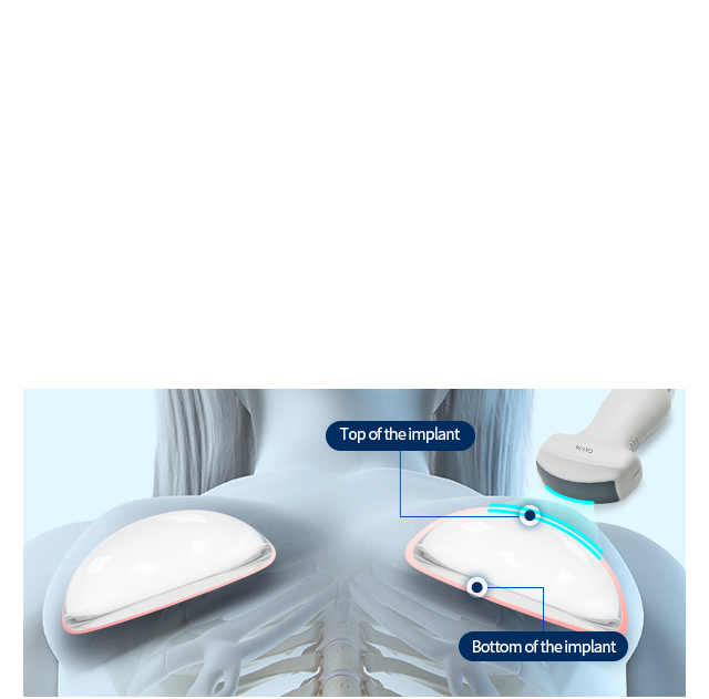 Capsule From Implant Through Full HD Ultrasound