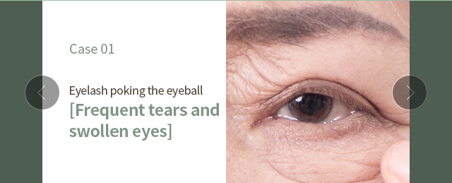 Eyelash poking the eyeball [Frequent tears and swollen eyes]