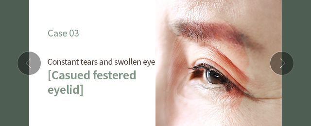 [Constant tears and swollen eye] [casued festered eyelid]