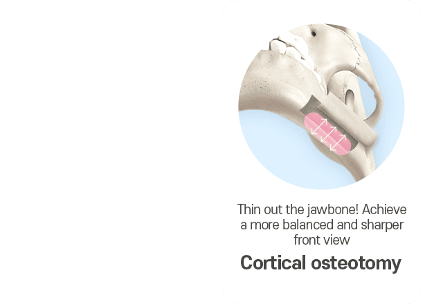 cortical osteotomy