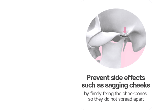 Prevent side effects such as sagging cheeks by firmly fixing the cheekbones so they do not spread apart