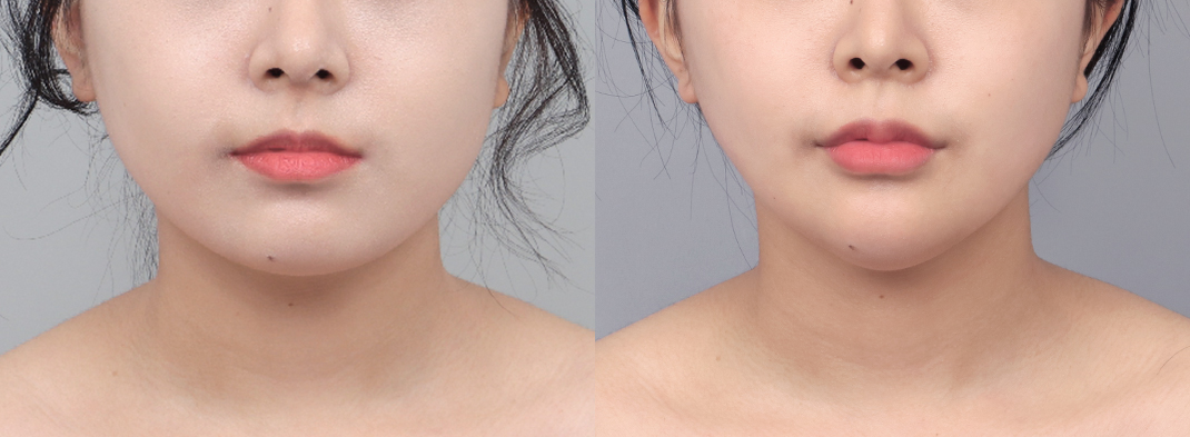 Revision difficulty level 1 view images