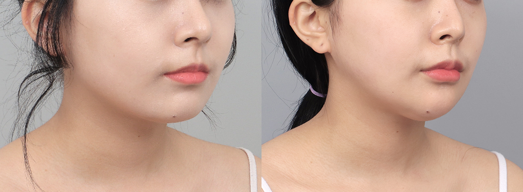 Revision difficulty level 1 view images