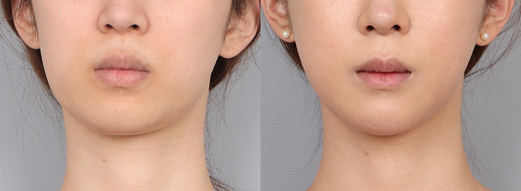 Revision difficulty level 2 view images