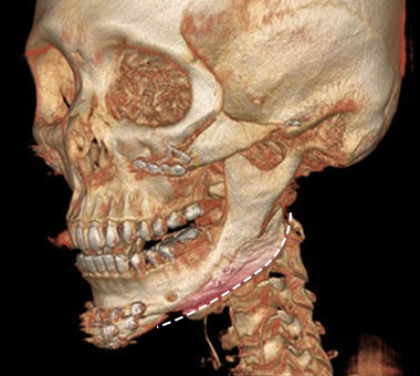 Reconstructed as a prosthesis that fits my jawbone.