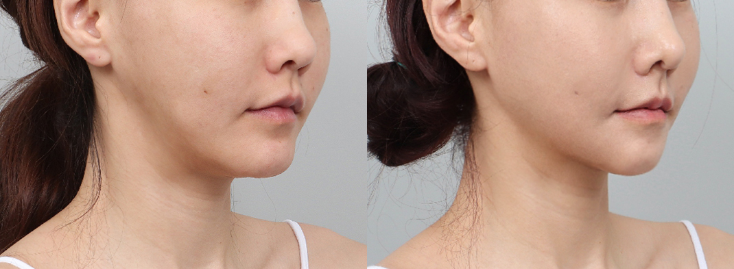 Revision difficulty level 4 view images