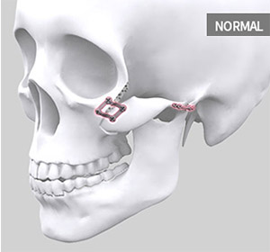 The standard method cuts the area where the cheekbone will be clinched more than the actual size of the bone and just clinching the cheekbone back to this area without extra procedures.