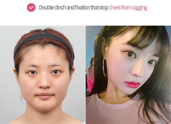 Double clinch and fixation that stop cheek from sagging