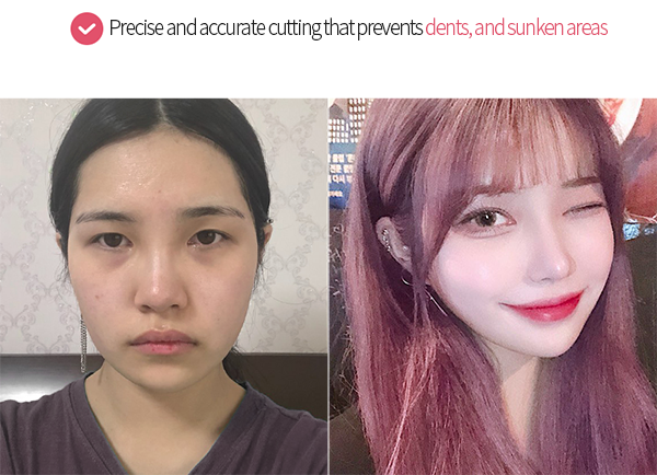 Precise and accurate cutting that prevents dents, and sunken areas