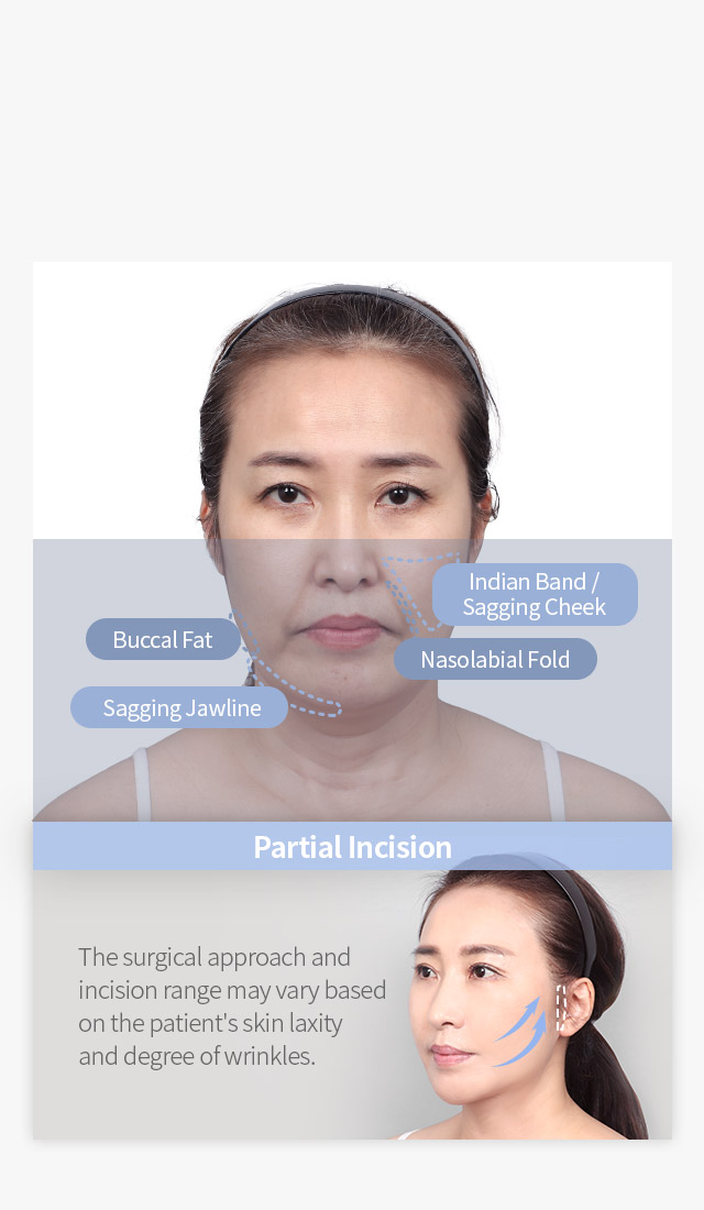 Full Face Lifting Improving Areas image