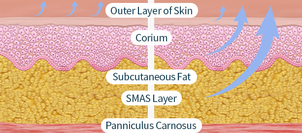 Lifting Only the Skin & Lifting With the SMAS Layer images