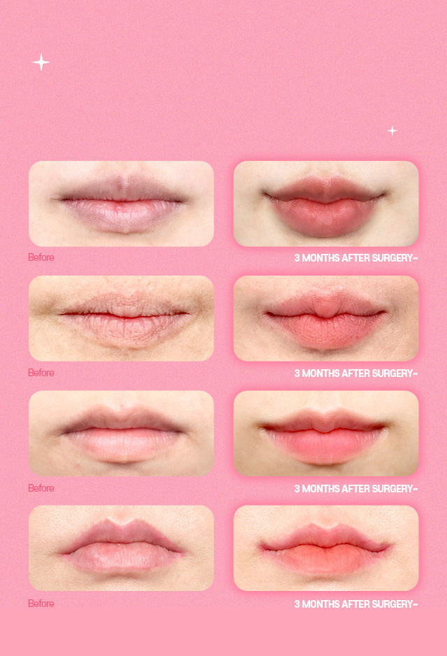 corner lip lift before and after