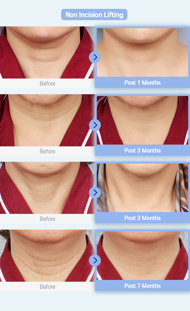 Non Incisional Lifting Before & After