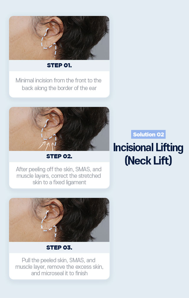 Definitely Improve With DA Neck Lifting! Solution 02.Incisional Lifting(Neck Lift)