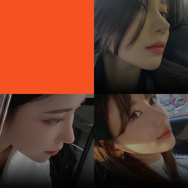 DA Autologous Cartilage Rhinoplasty