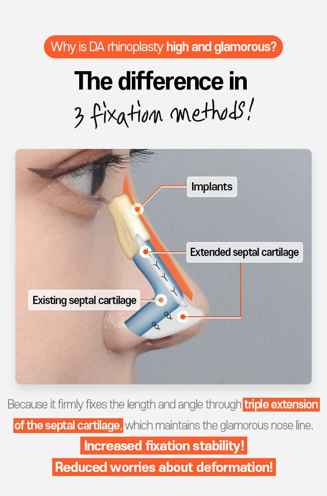 why is DA rhinoplasty hight and glamorous? the difference in 3 fixation methods!