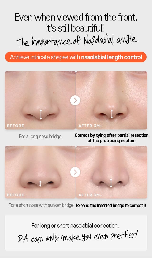 Even when viewed from the front, it's still beautiful! The importance of Nasolabial angle