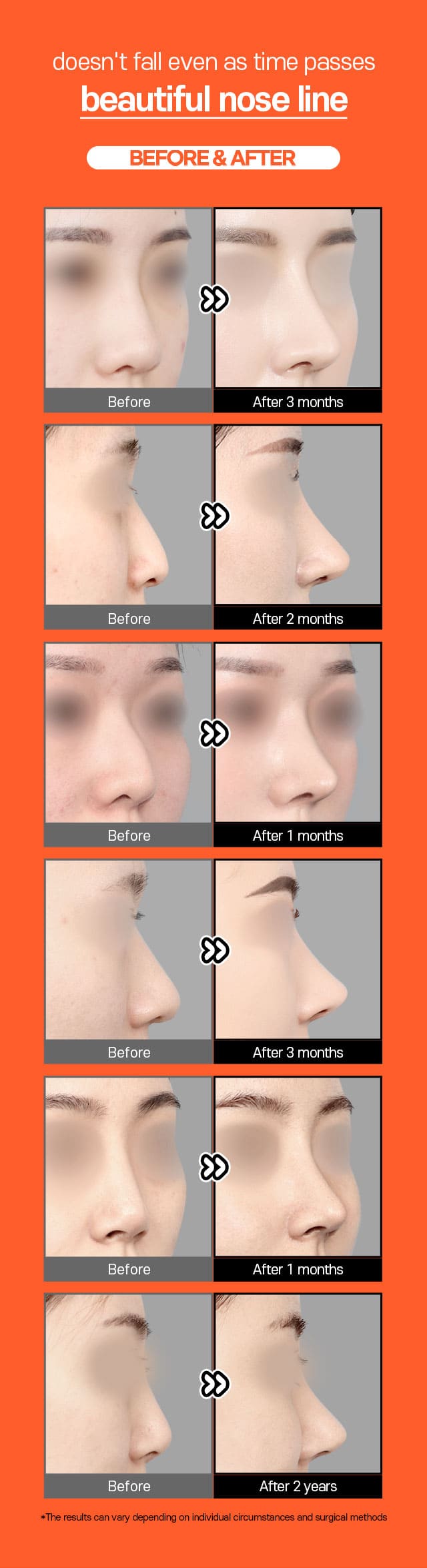 A beautiful nose line that doesn't fall even as time passes