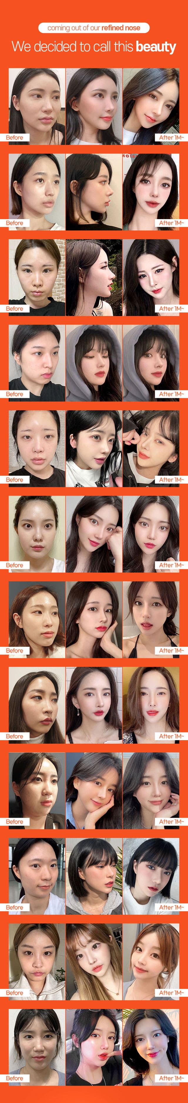 We decided to call this beauty coming out of our refined nose! DA Autologous Cartilage Rhinoplasty