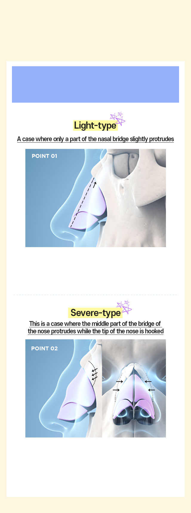 DA Surgical method for Hump nose removal rhinoplasty-Step01.By cases