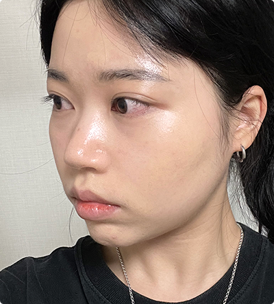 A preoperative Real Model of DA Revision Nose Plastic Surgery