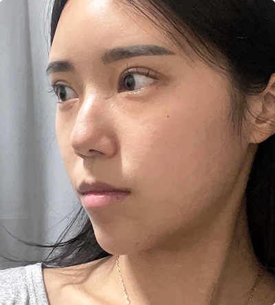 A preoperative Real Model of DA Revision Nose Plastic Surgery