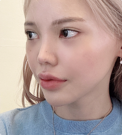 A preoperative Real Model of DA Revision Nose Plastic Surgery