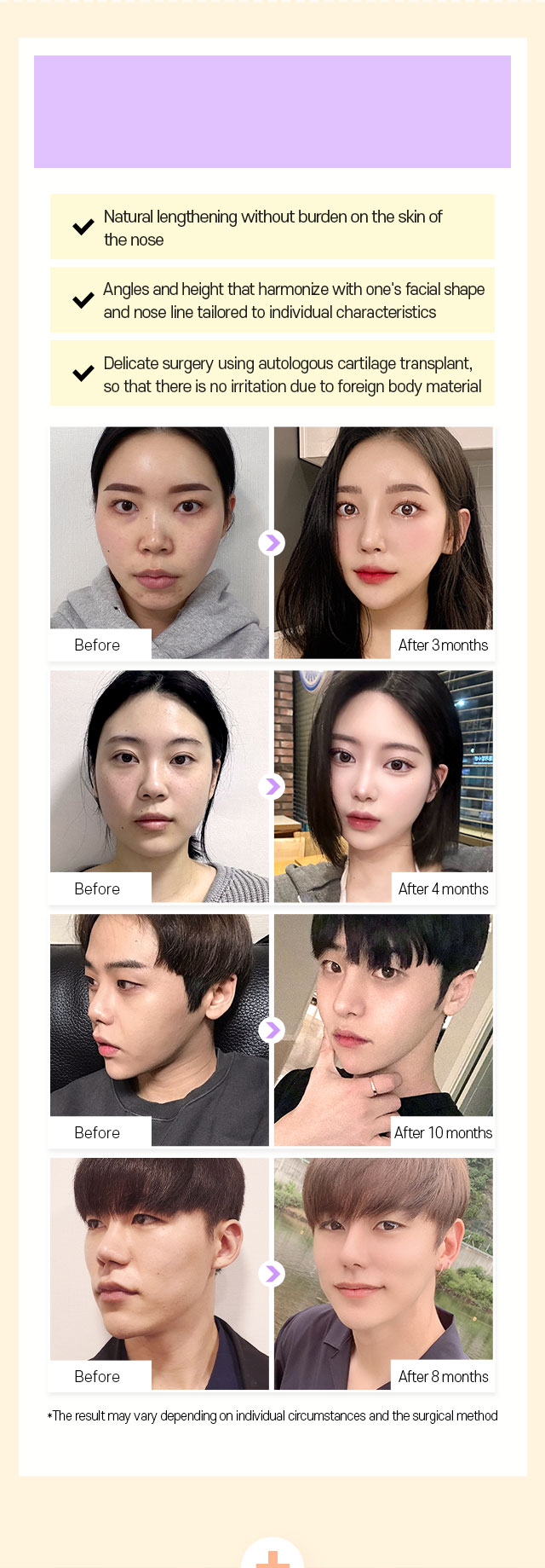 DA Short, Upturned nose correction DA’s own POINT