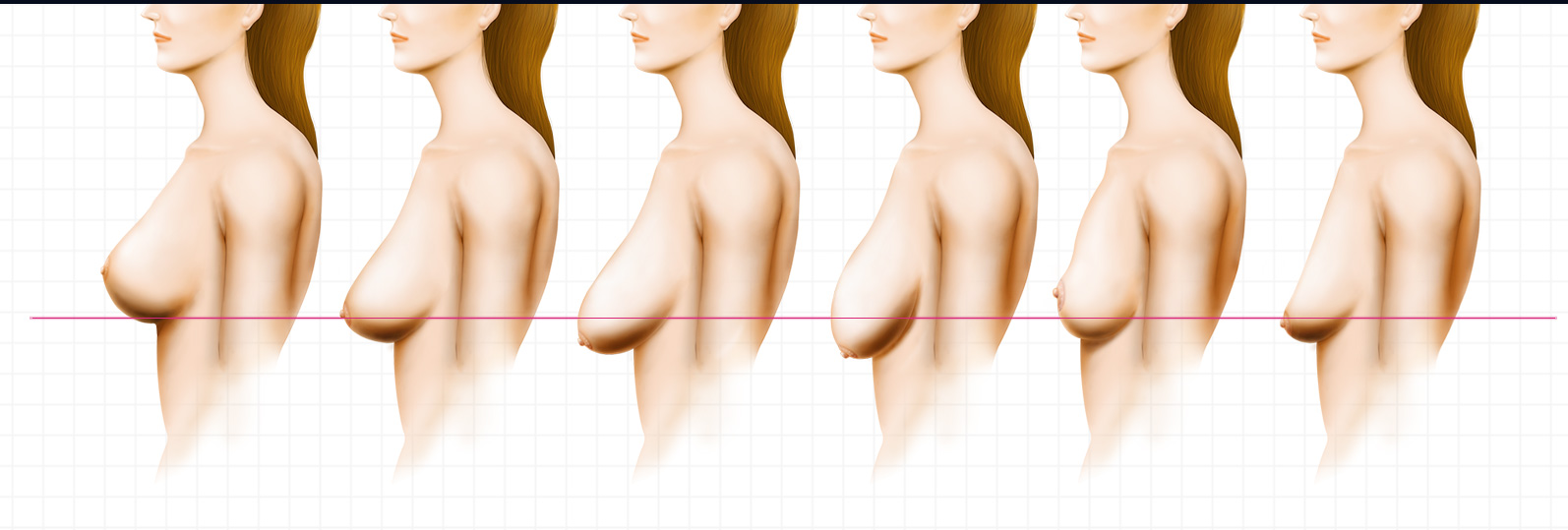 Self Diagnosis Method For Saggy Breasts