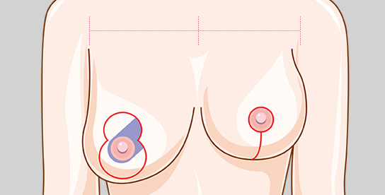 Moderate-Breast Hypertrophy
