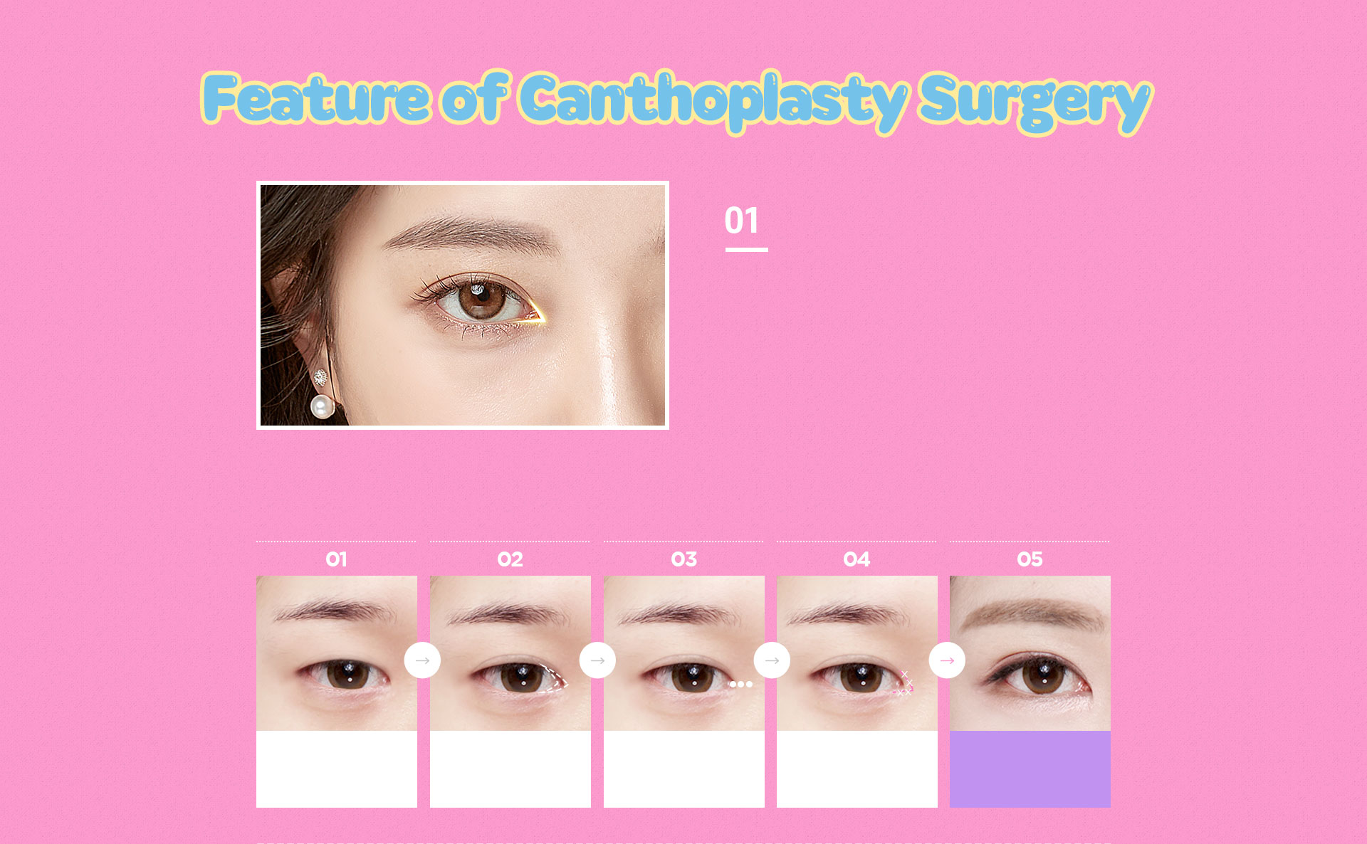 DA Canthoplasty Surgery