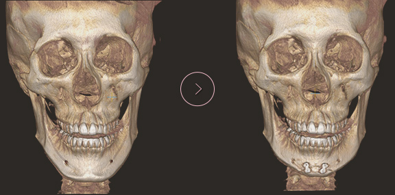 chin length CT BEFORE & AFTER