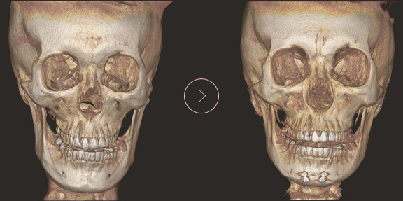 chin length CT BEFORE & AFTER