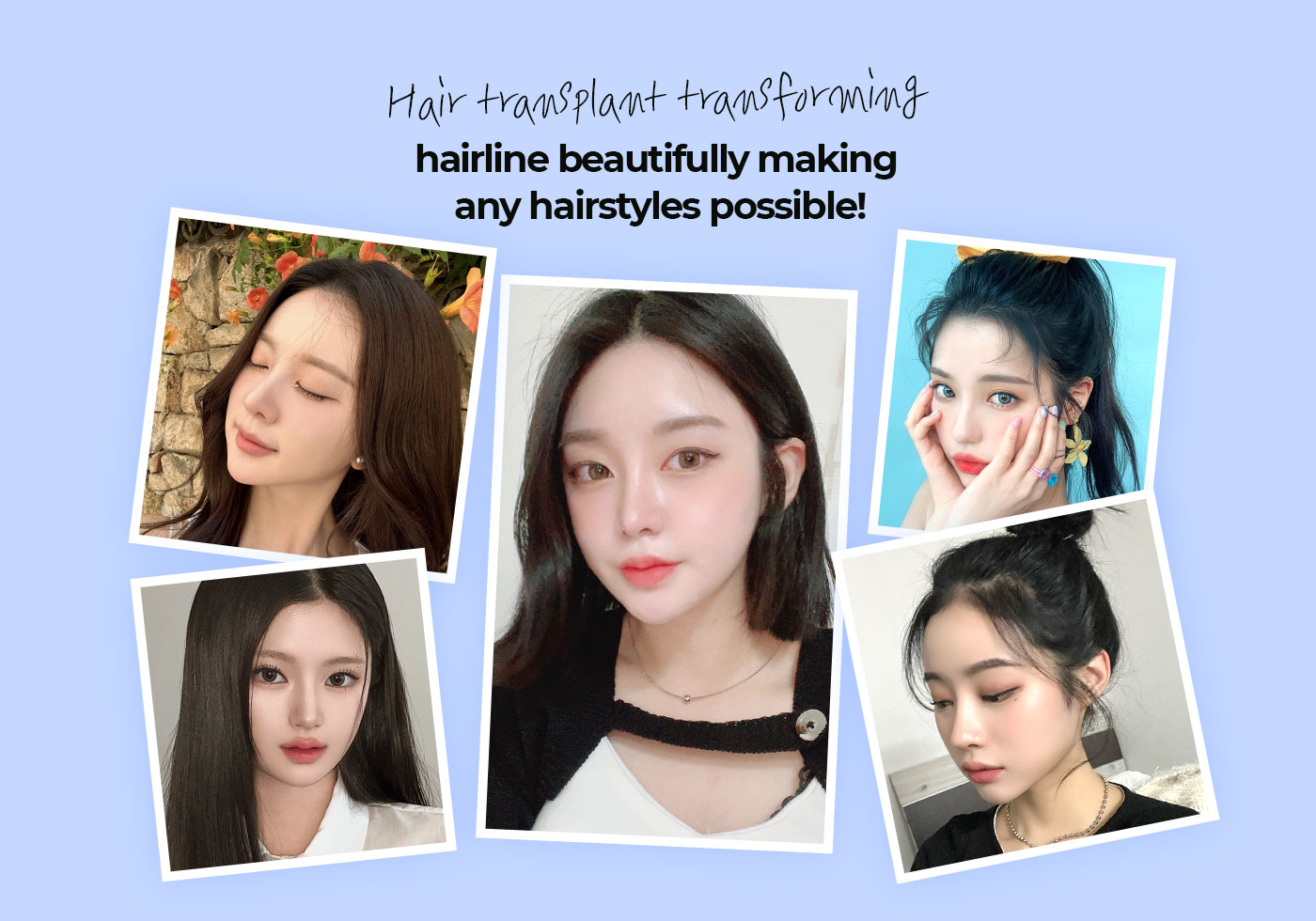 Hair transplant transforming hairline, beautifully making any hairstyles possible!