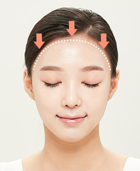 Forehead Reduction Surgery Method 03
