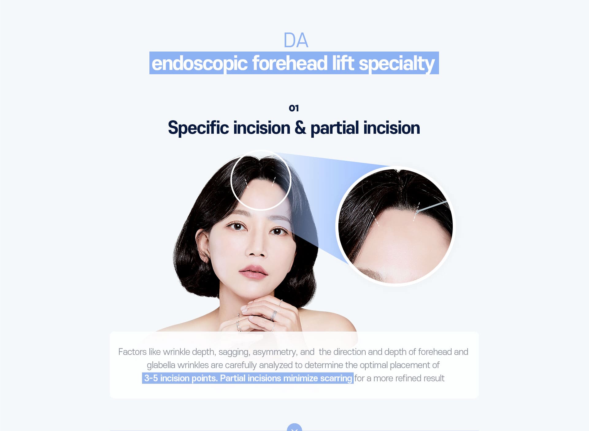 DA endoscopic forehead lift specialty - 01.Specific incision & partial incision
