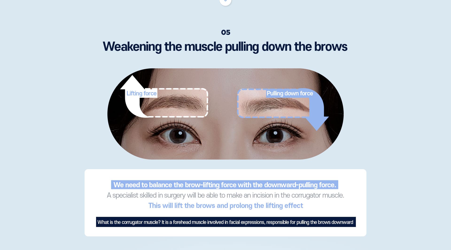 DA Endoscopic Forehead Lift specialty - 05.Weakening the muscle pulling down the brows